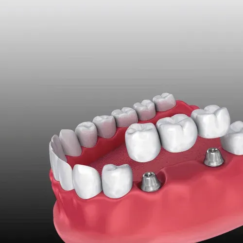 Dental Bridge