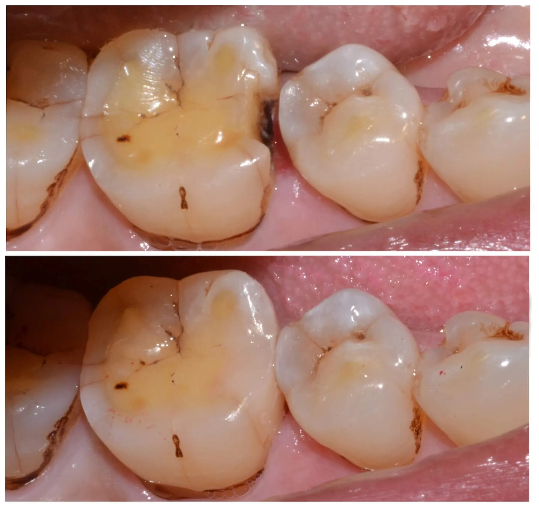 Porcelain Dental Fillings