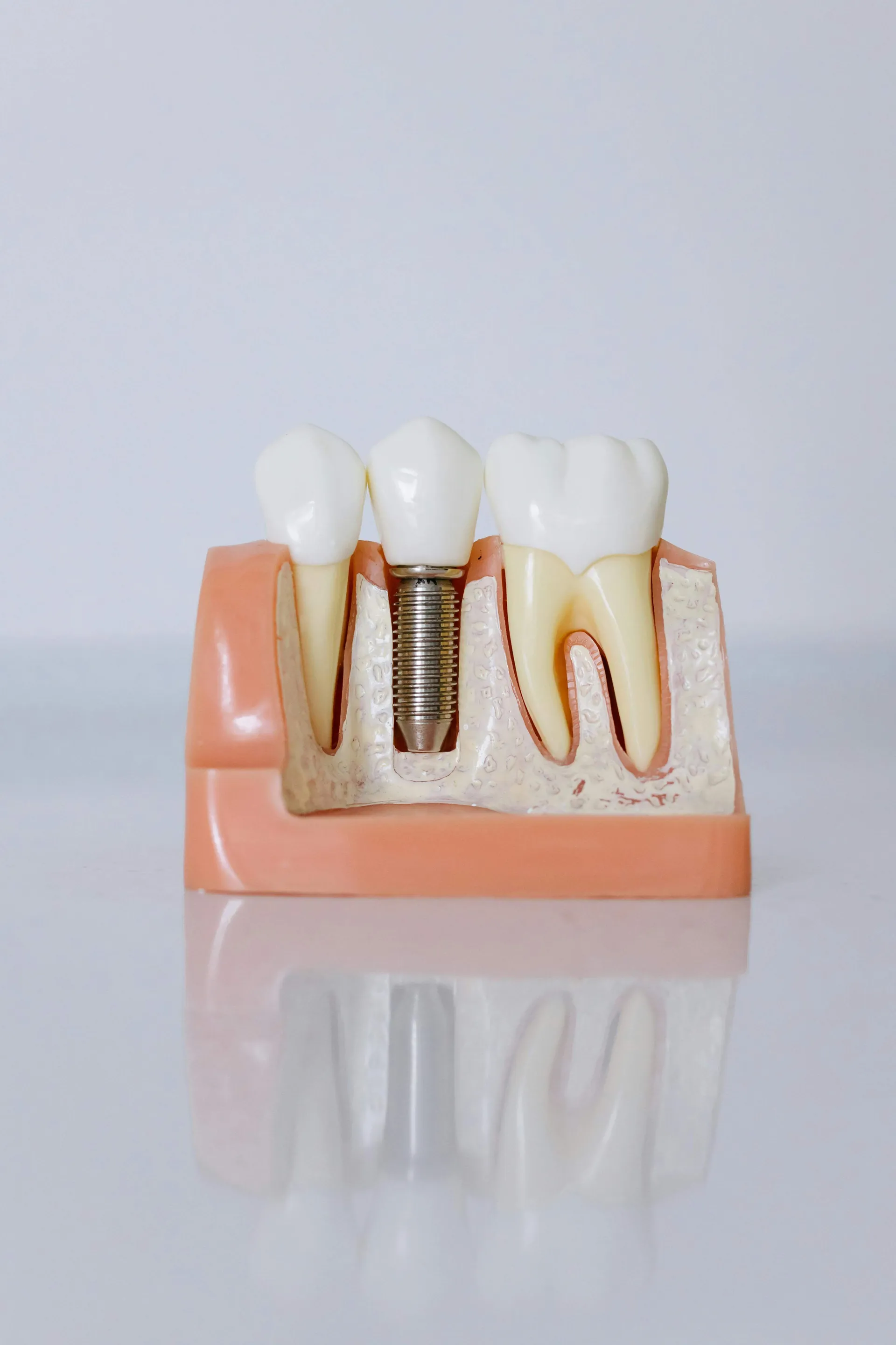 Single or Multiple Dental Implants