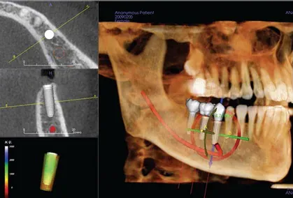 Bringing Your Smile To The Next Step With Computer-Guided Technology