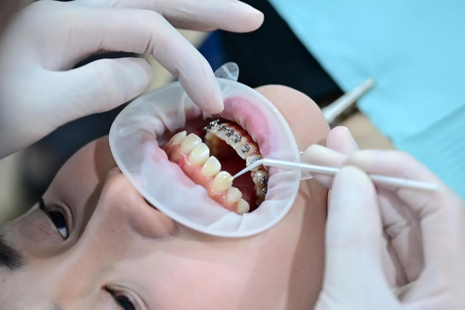 Self Ligating Braces