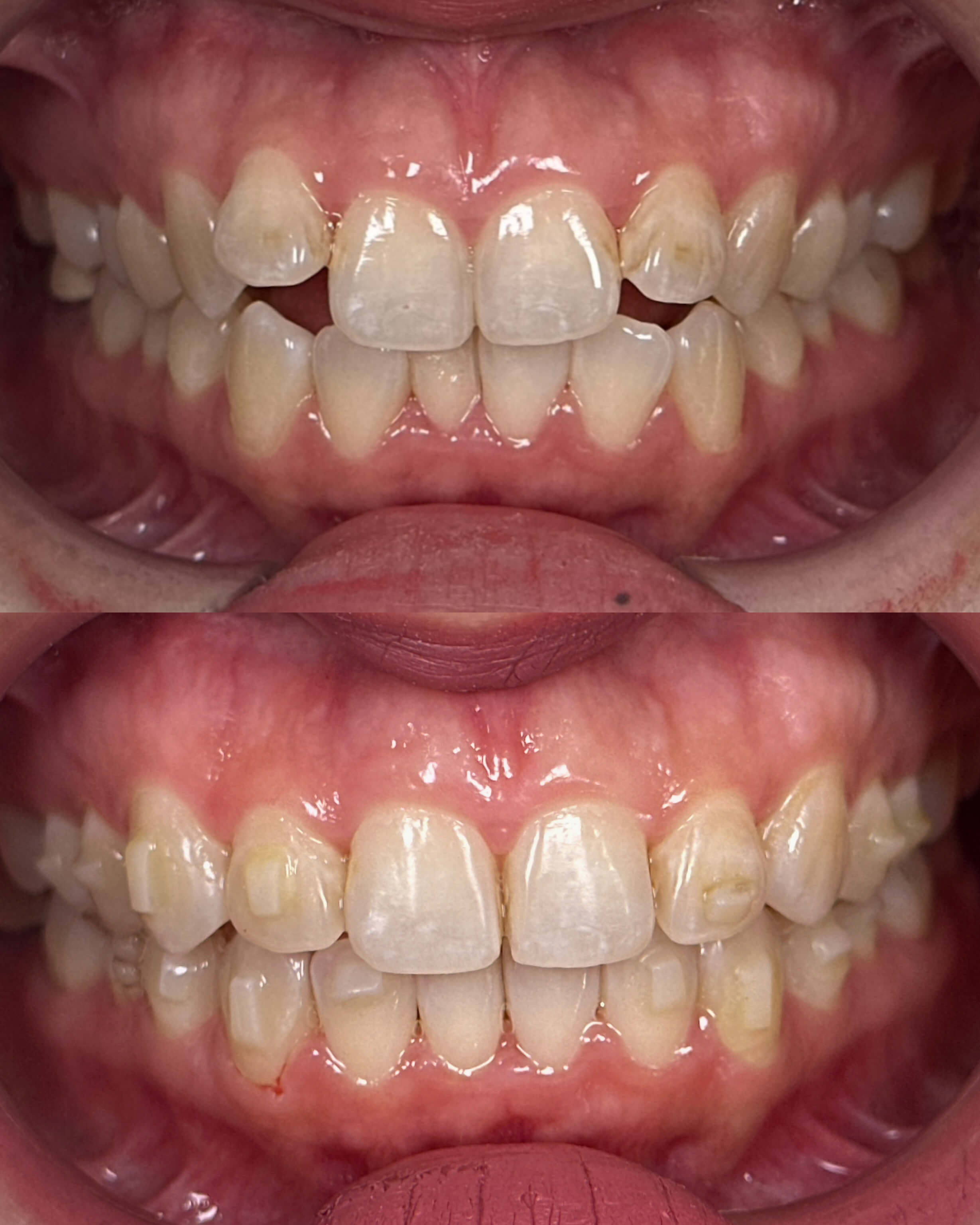 A before-and-after image of a person's smile after cosmetic dentistry treatment.