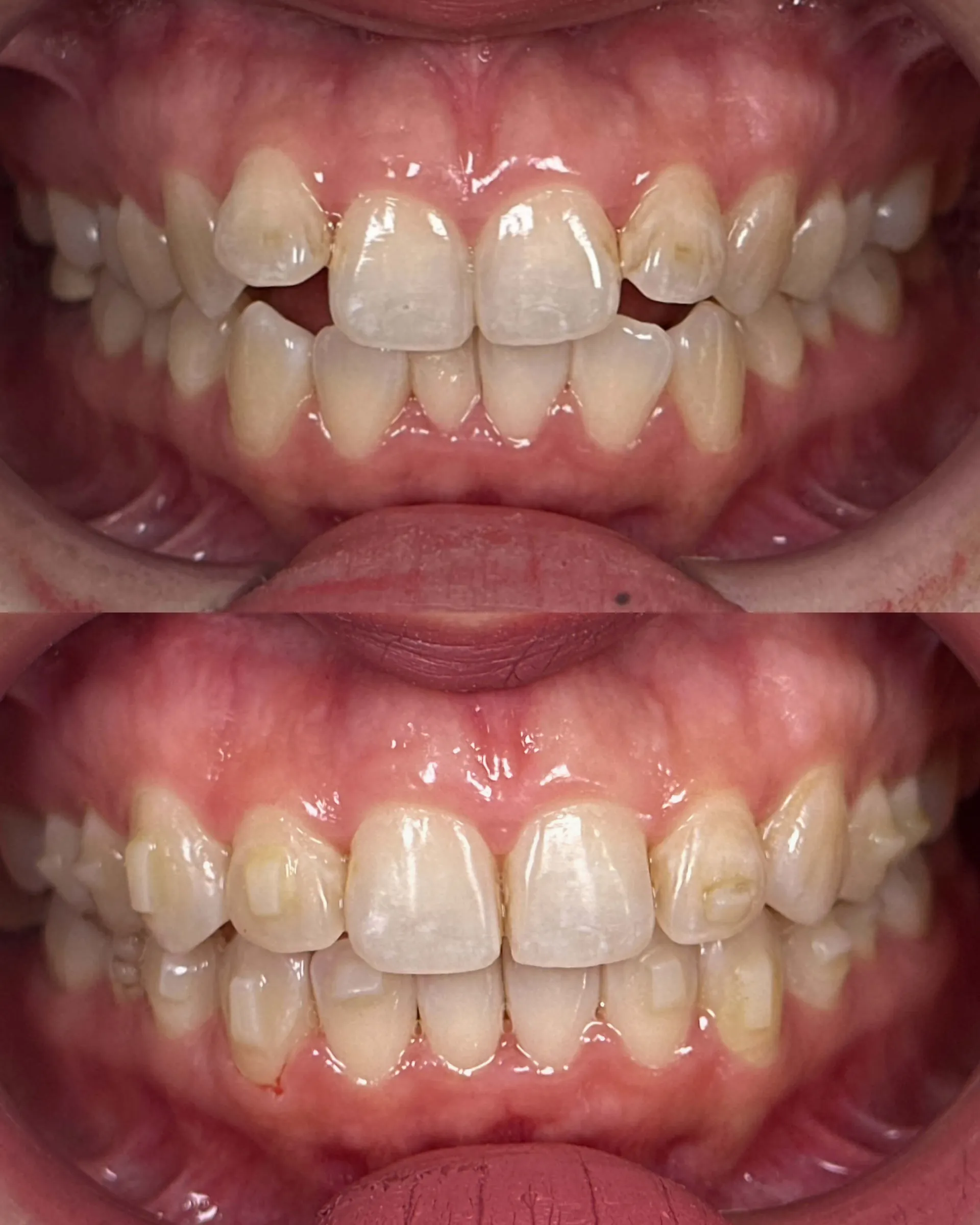 Before and after smile transformation