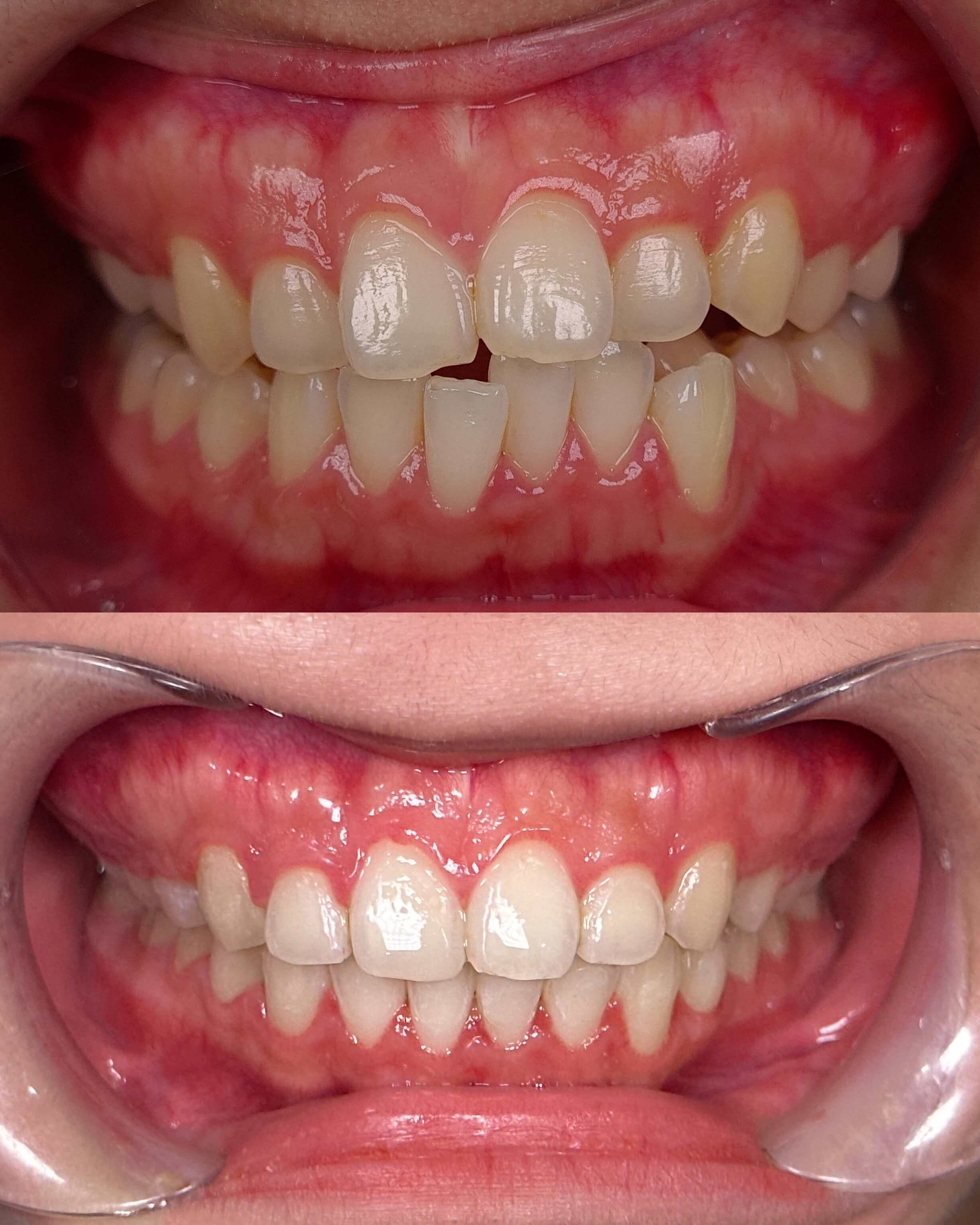 A before-and-after image of a person's smile after cosmetic dentistry treatment.