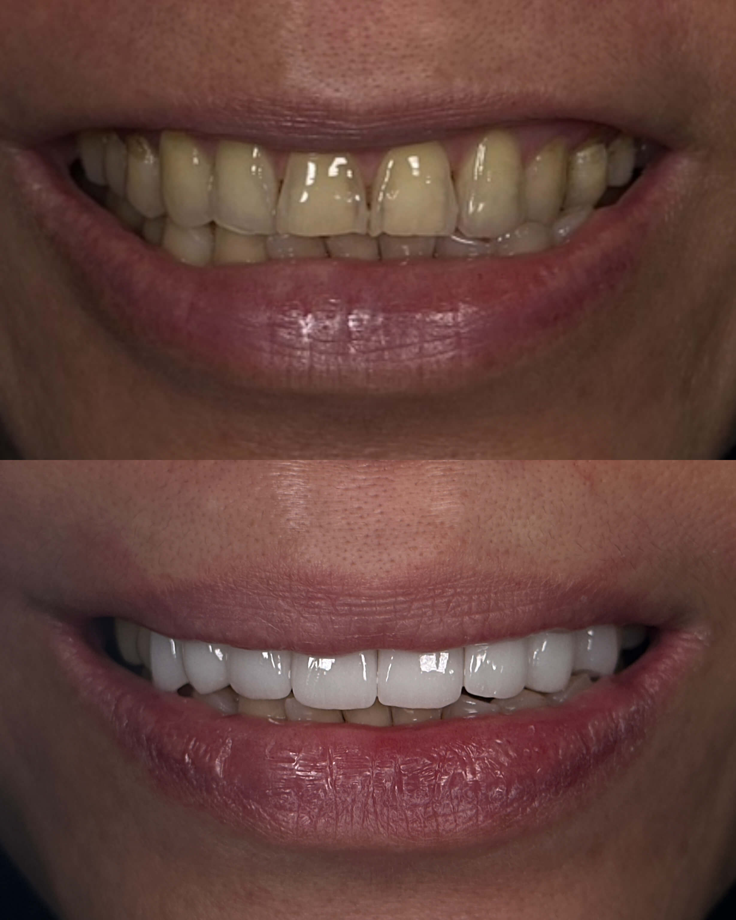 A before-and-after image of a person's smile after cosmetic dentistry treatment.