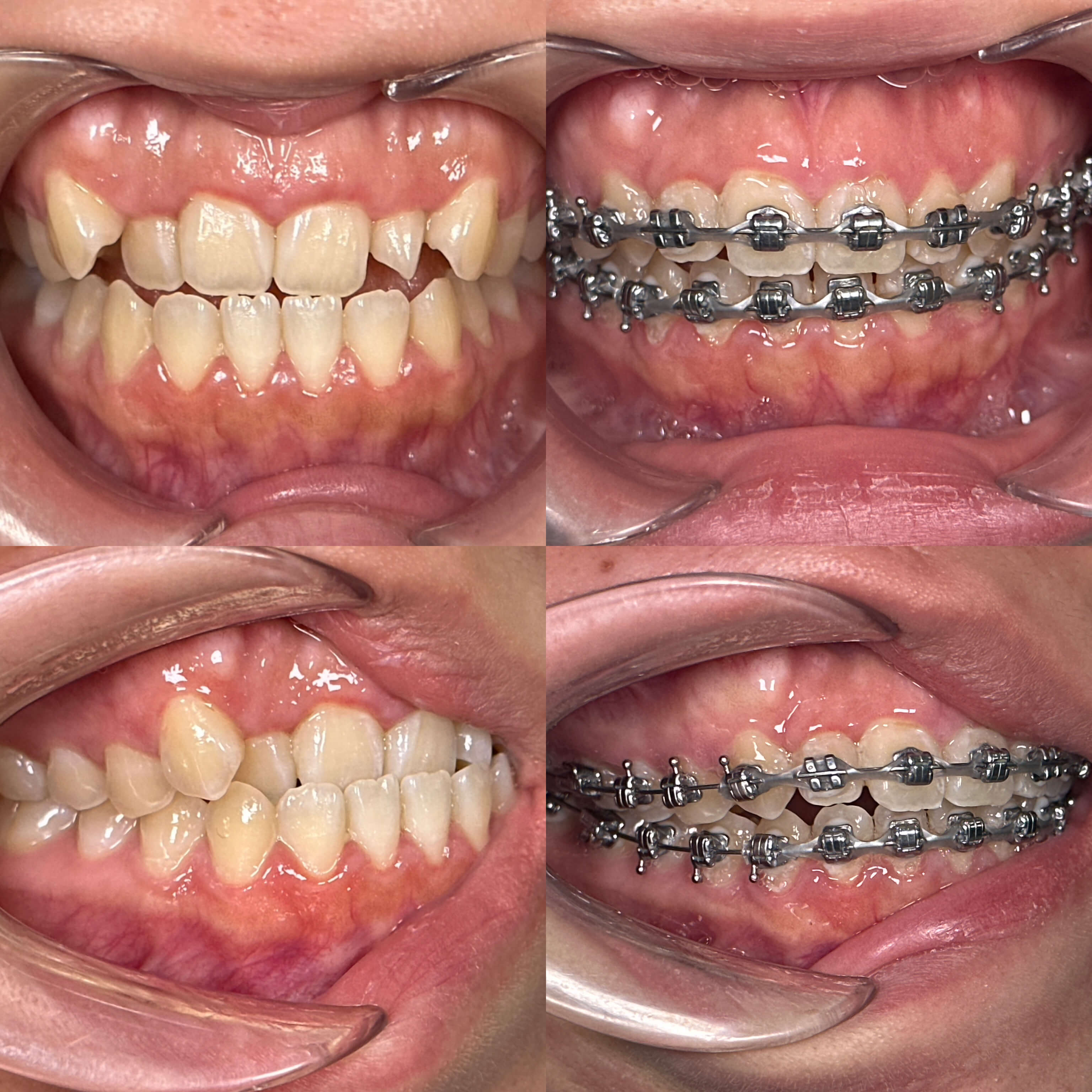 A before-and-after image of a person's smile after cosmetic dentistry treatment.