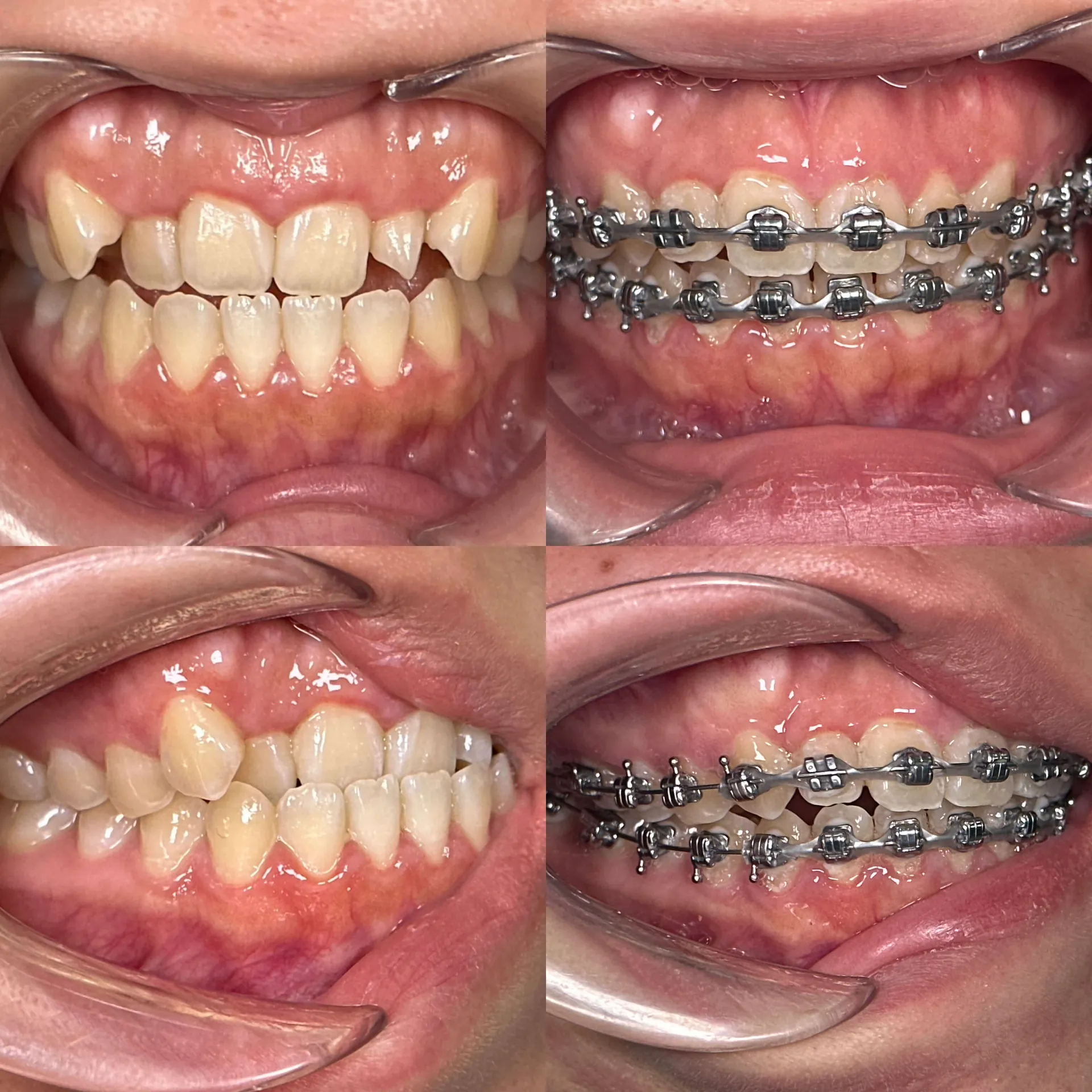 Before and after smile transformation