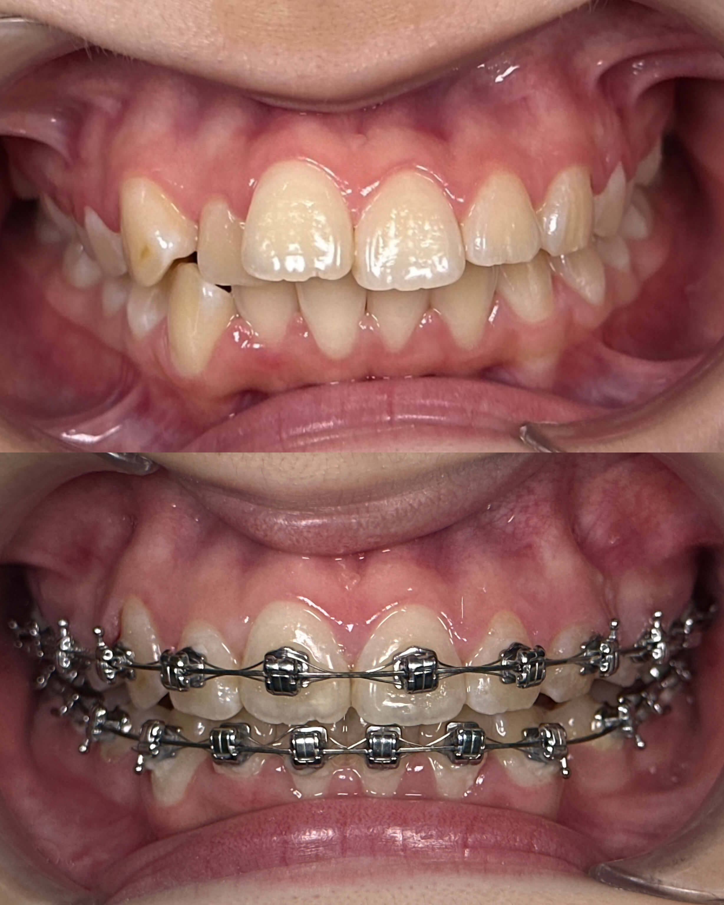 A before-and-after image of a person's smile after cosmetic dentistry treatment.