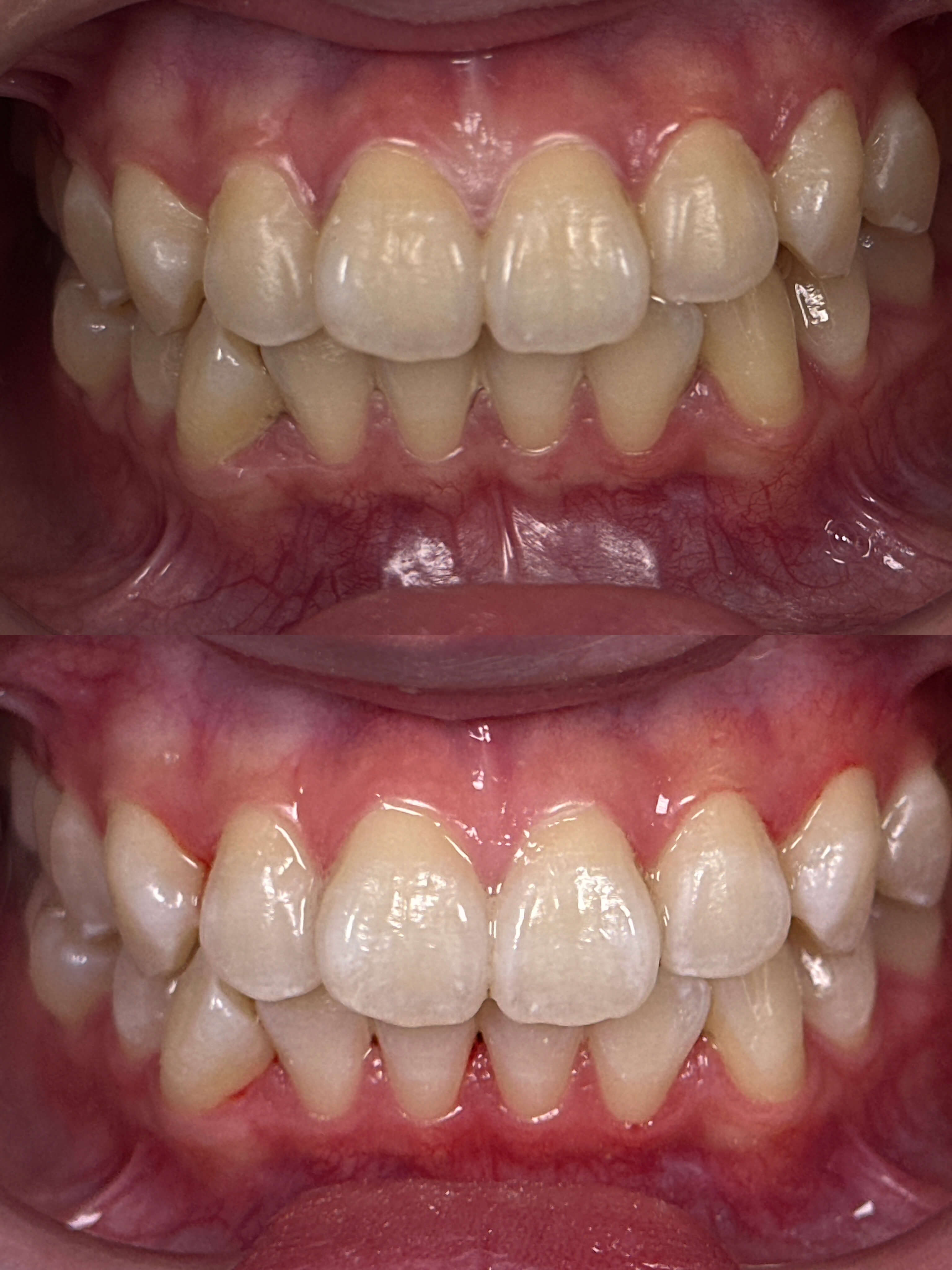 A before-and-after image of a person's smile after cosmetic dentistry treatment.