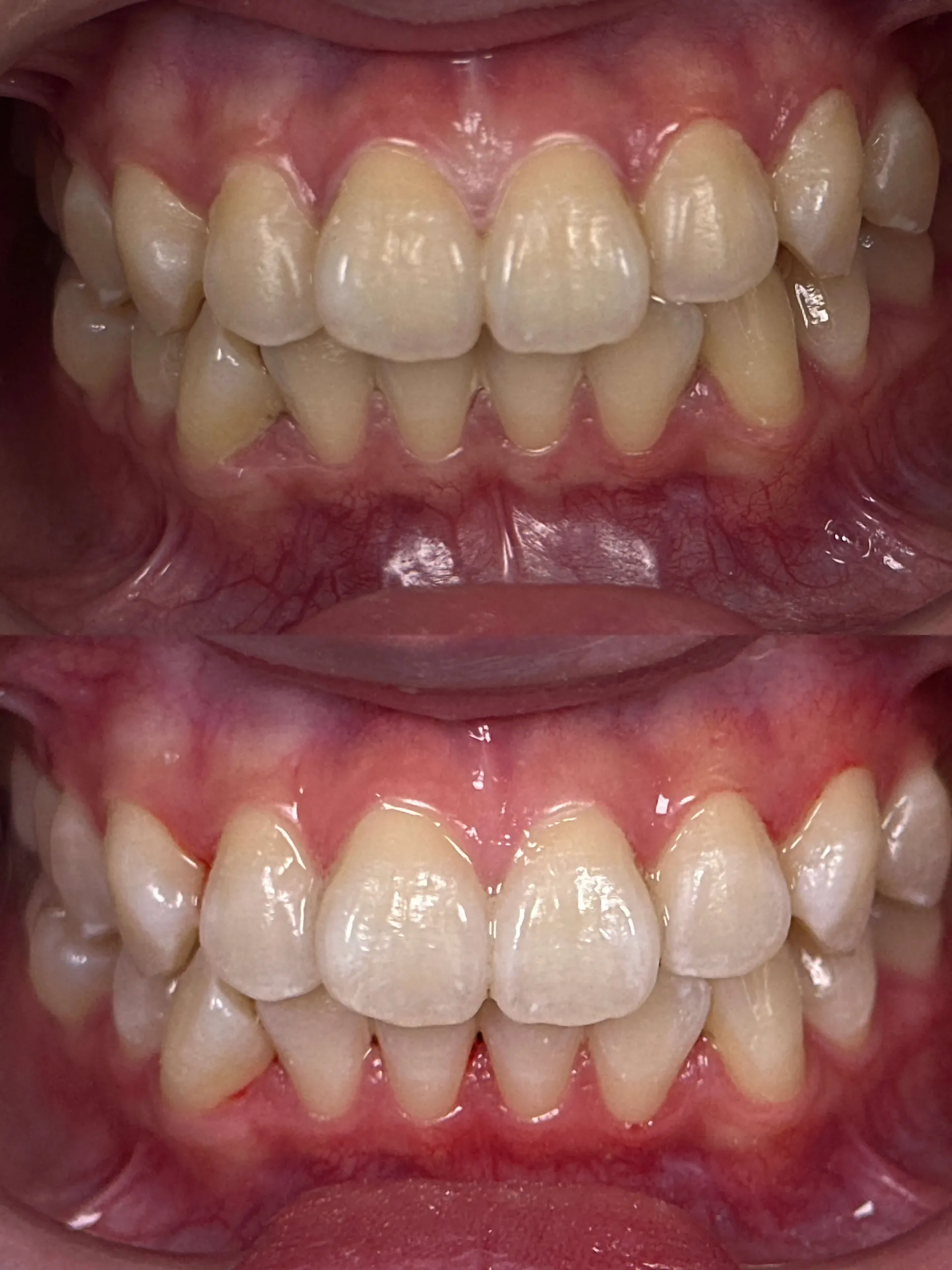 Before and after smile transformation