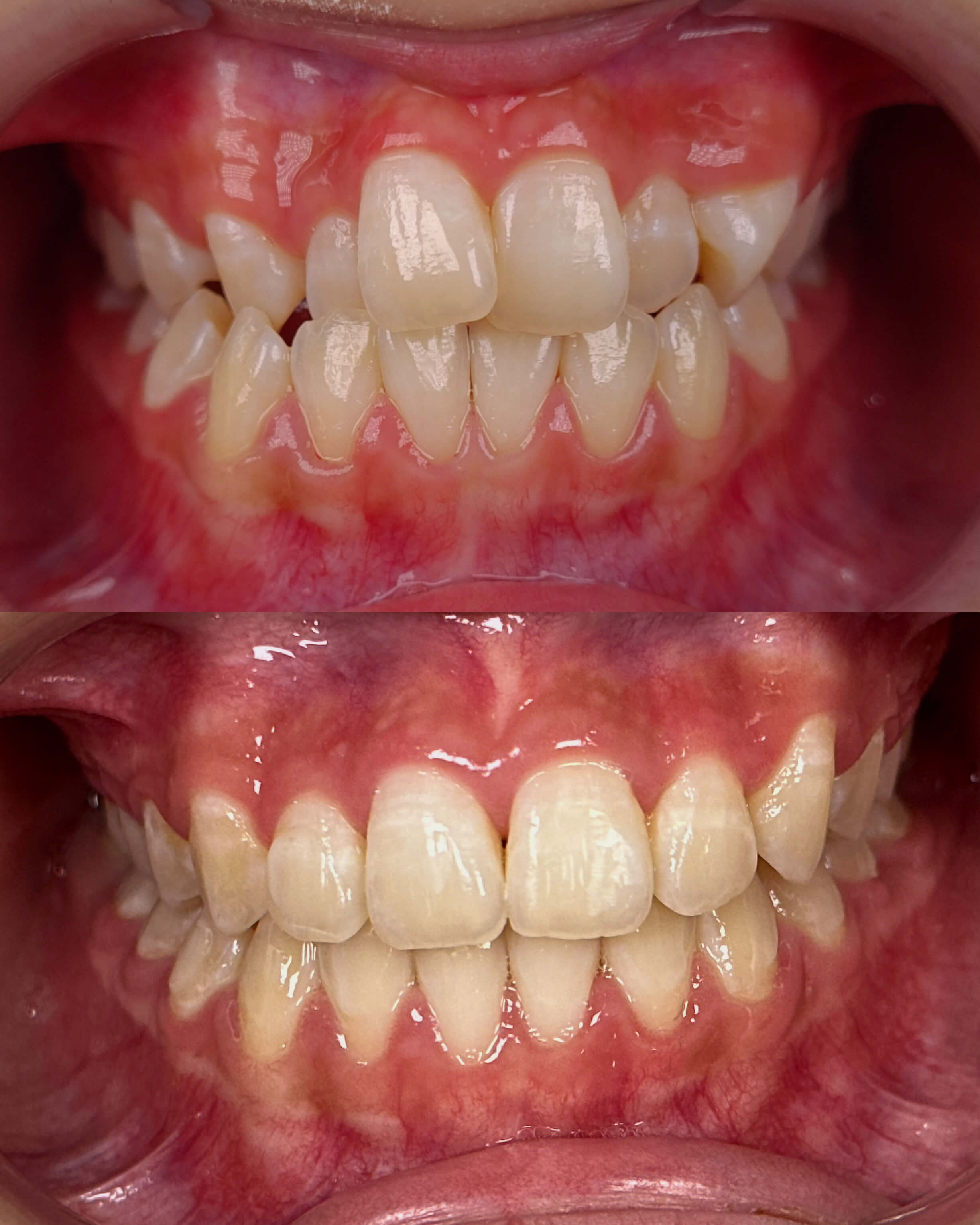 A before-and-after image of a person's smile after cosmetic dentistry treatment.