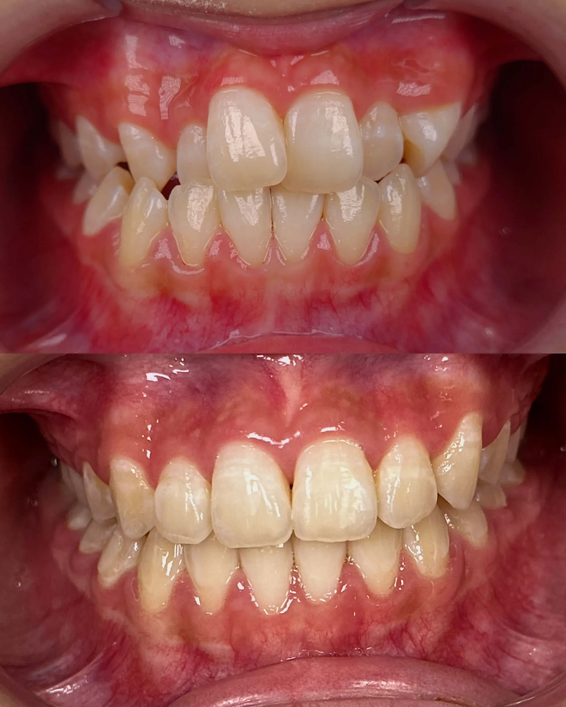 Before and after smile transformation