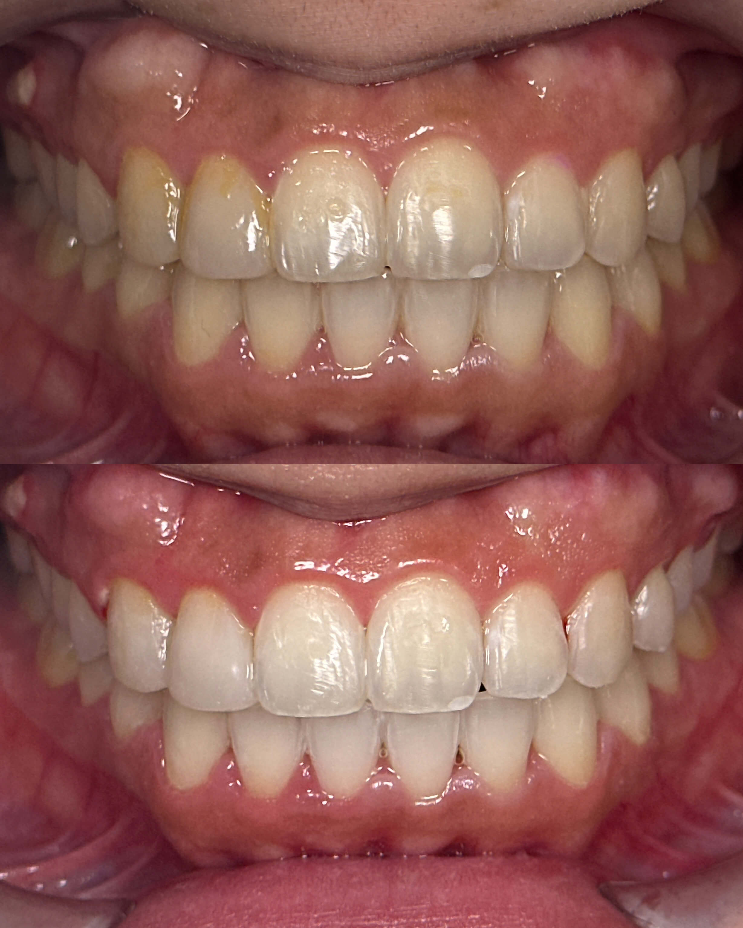 A before-and-after image of a person's smile after cosmetic dentistry treatment.