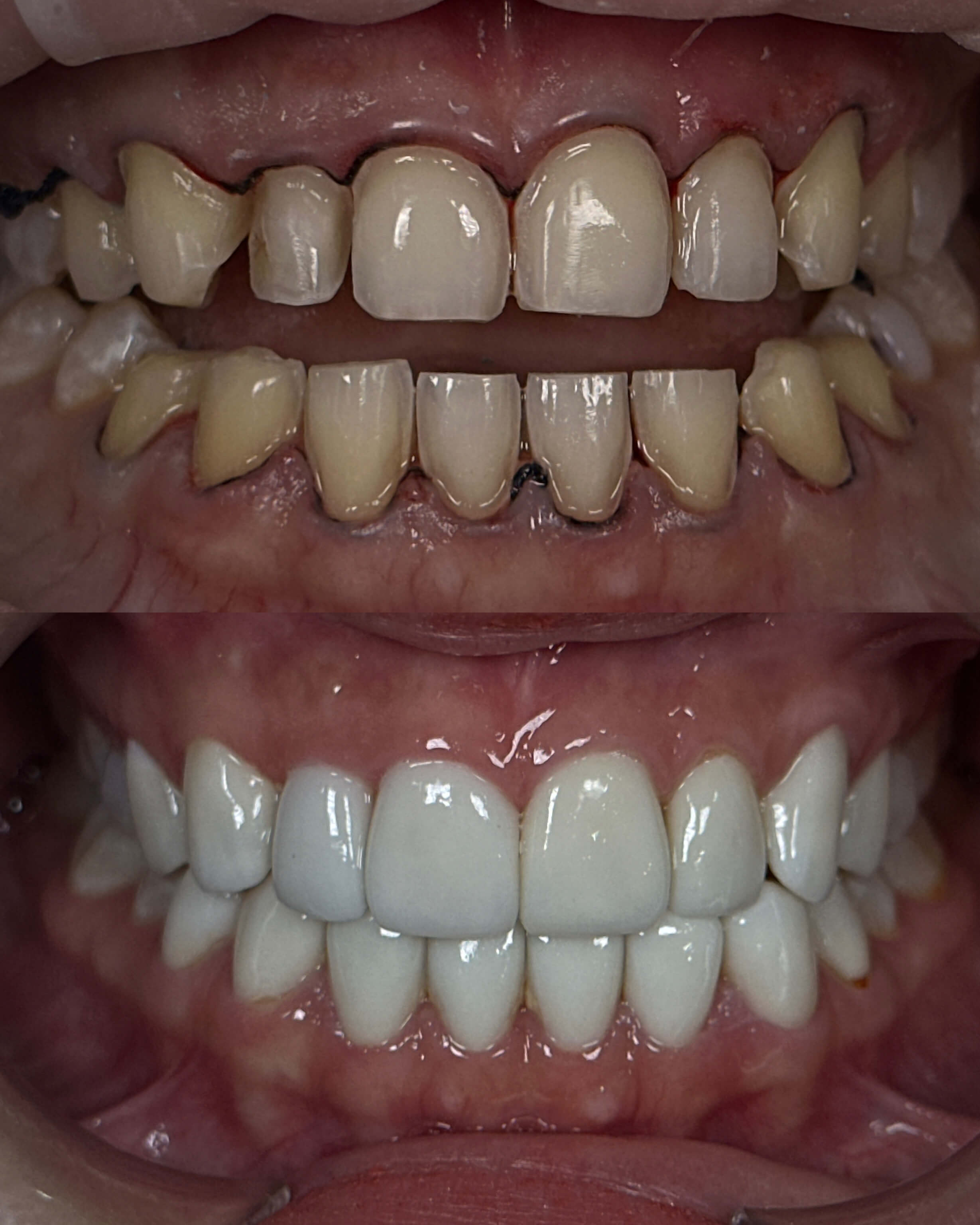 A before-and-after image of a person's smile after cosmetic dentistry treatment.