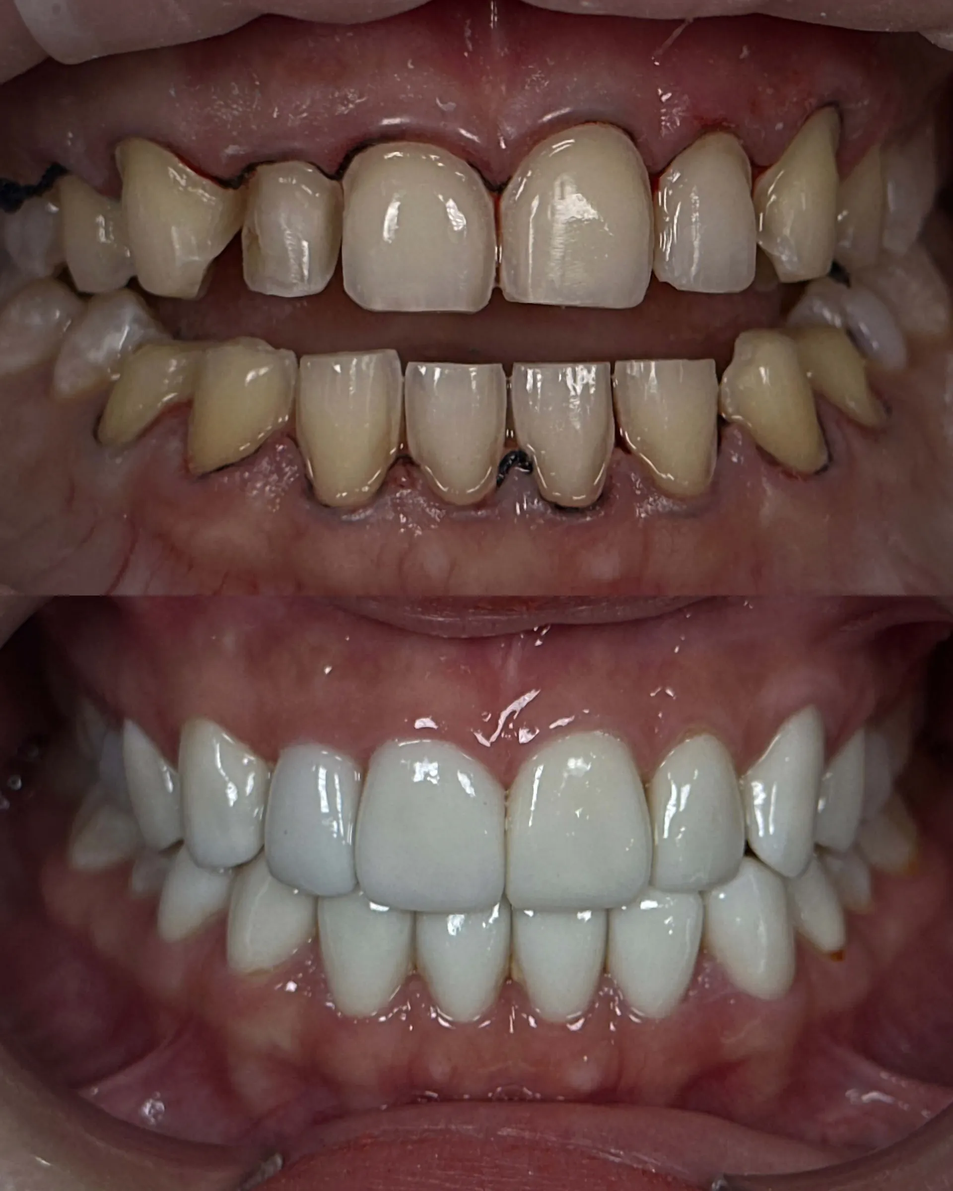 Before and after smile transformation