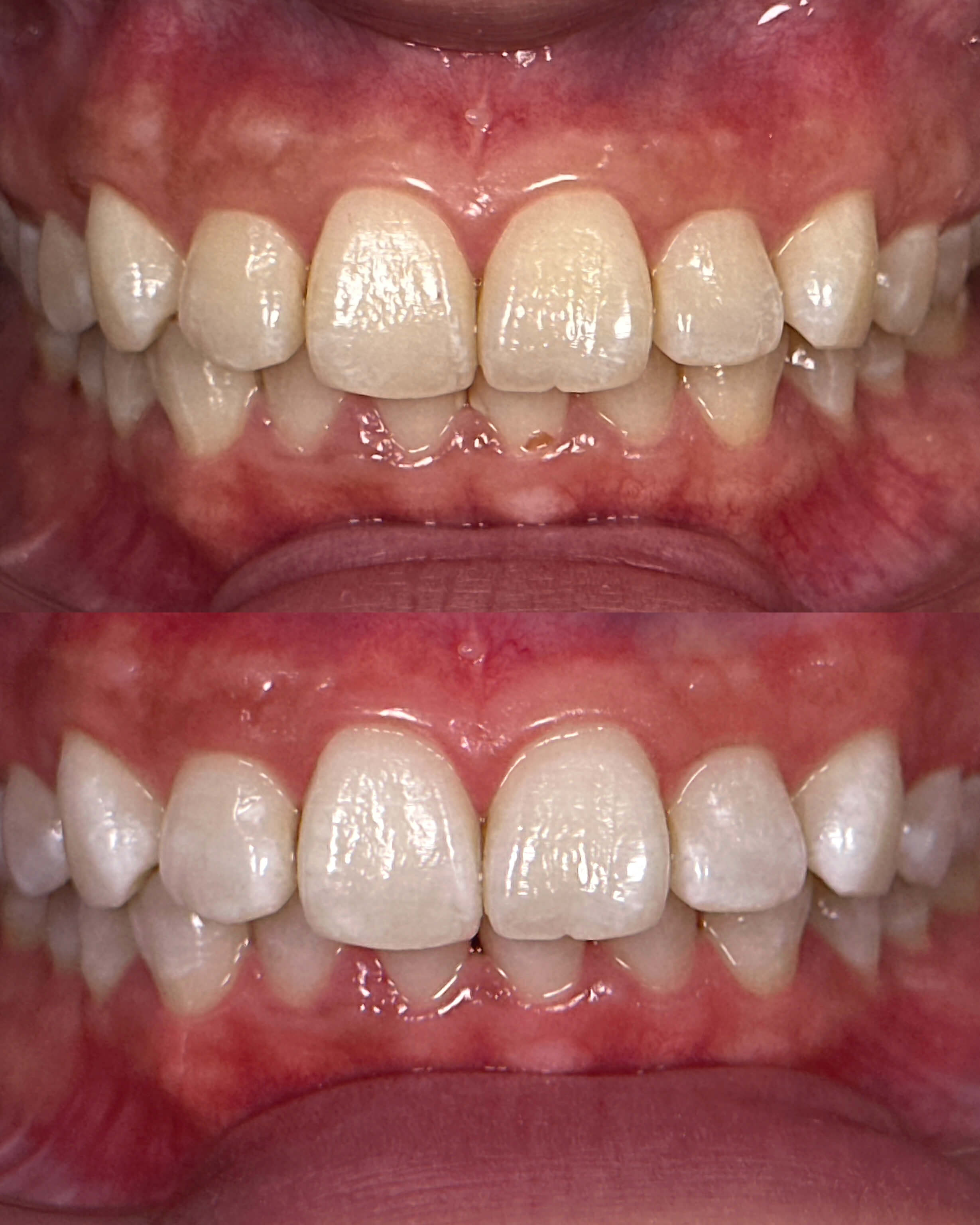 A before-and-after image of a person's smile after cosmetic dentistry treatment.