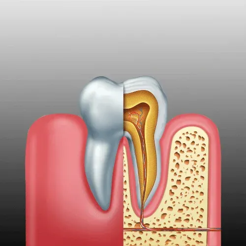Root Canal Treatment