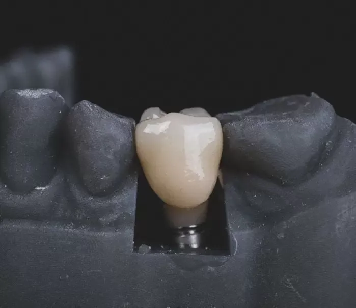 Single Dental Implants