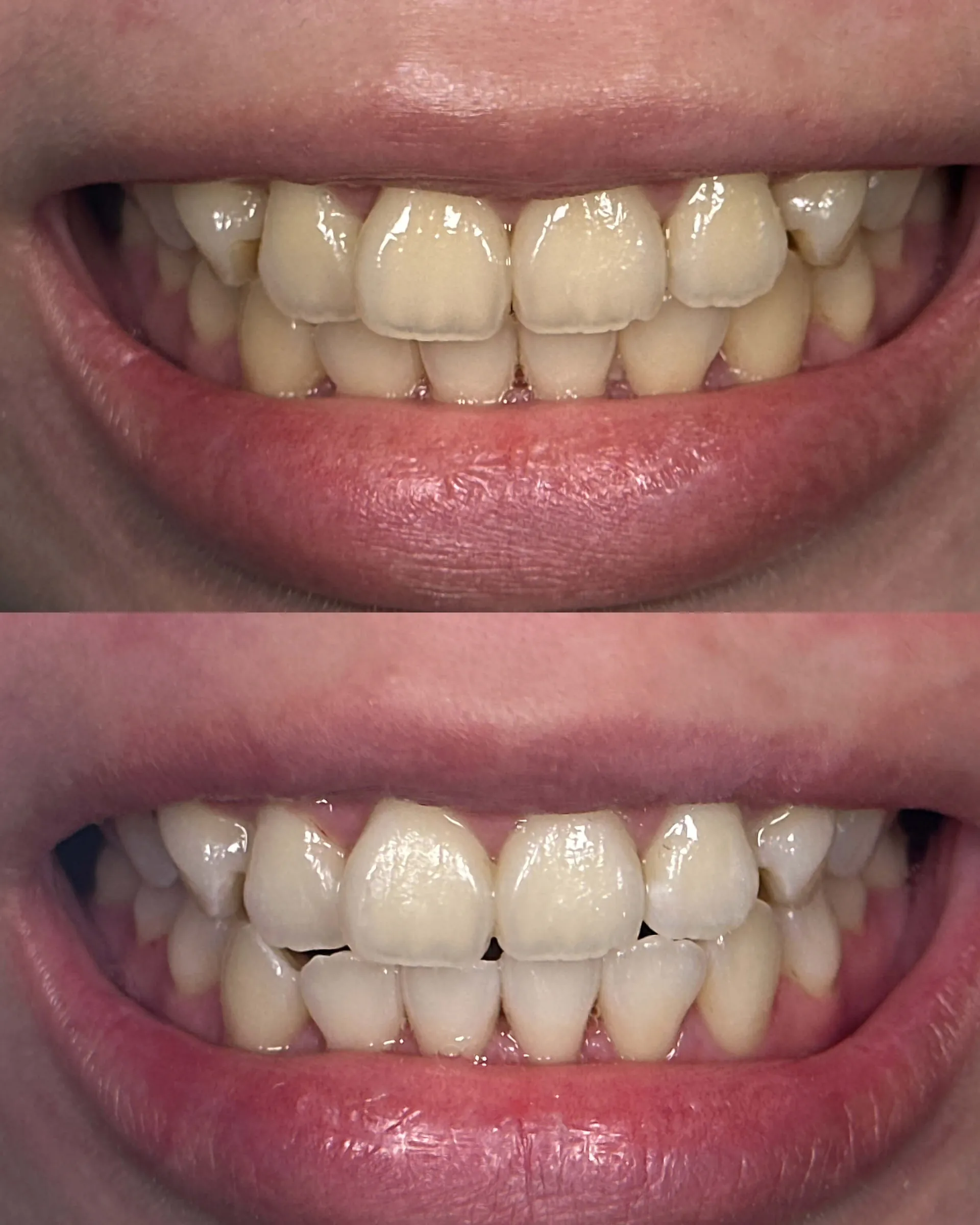 Professional Teeth Whitening