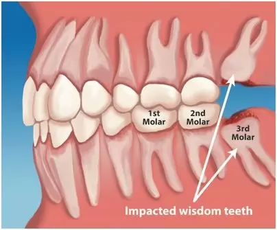 Wisdom Teeth Removal