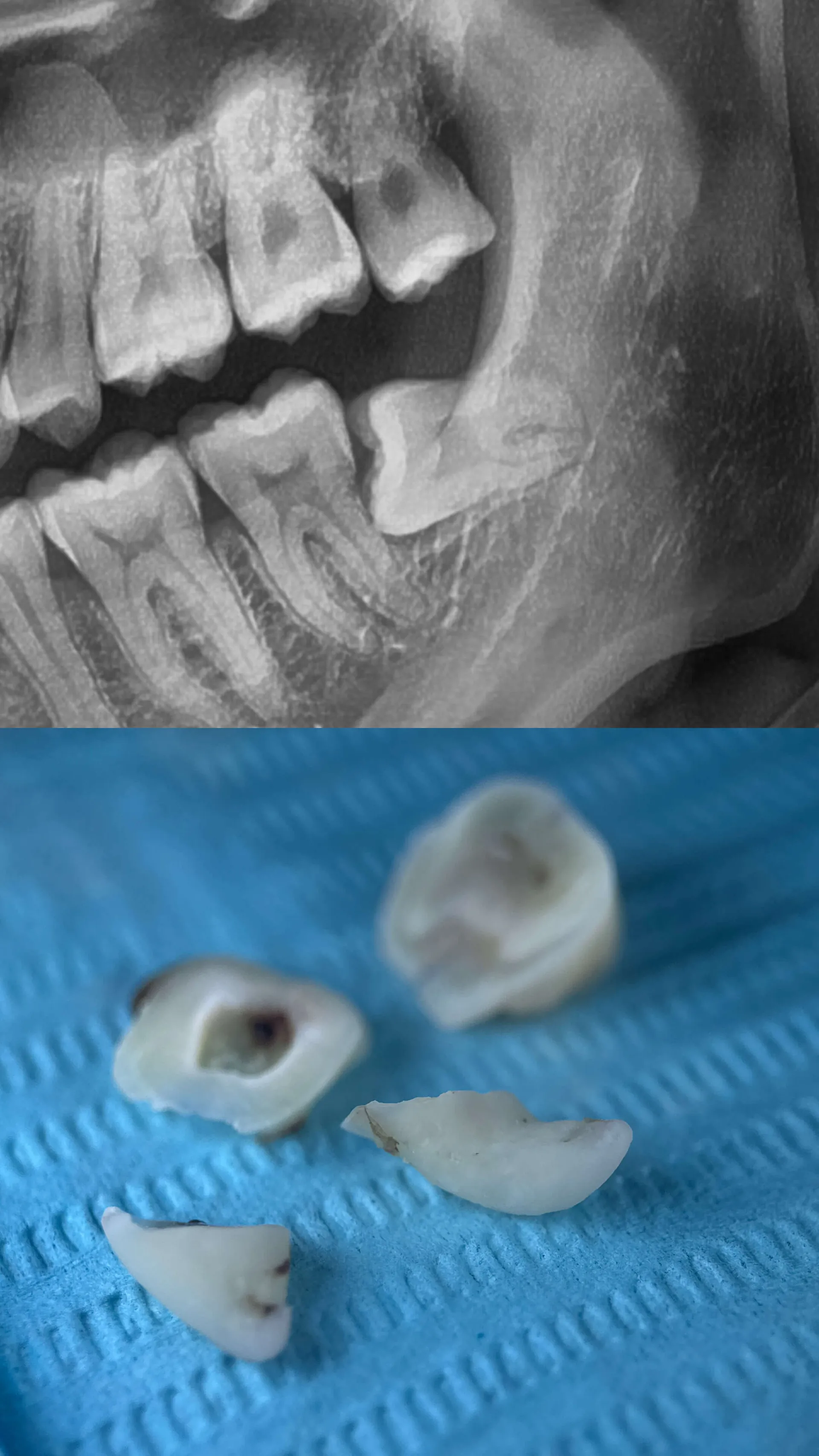 Wisdom Teeth Surgery